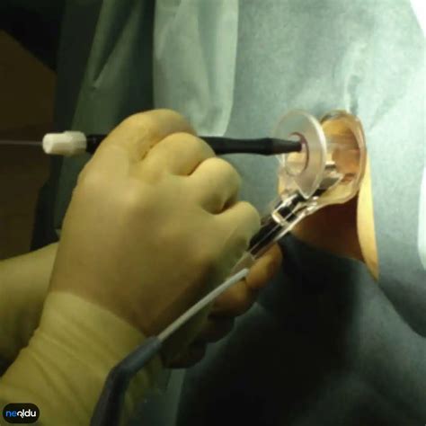 hemoroid lazer ameliyatı video